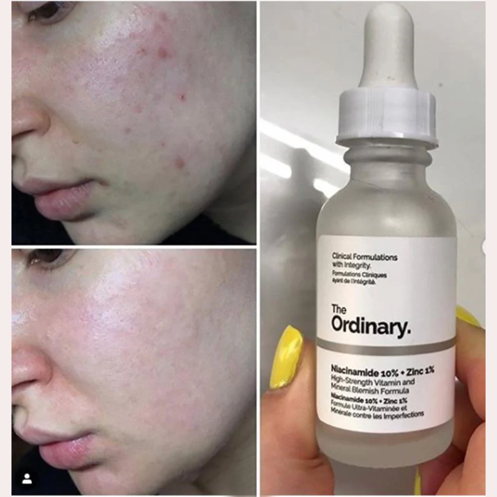 The Ordinary Niacinamide 10% and Zinc 1% facial serum bottle, clear 30ml for skin clarity and pore reduction.