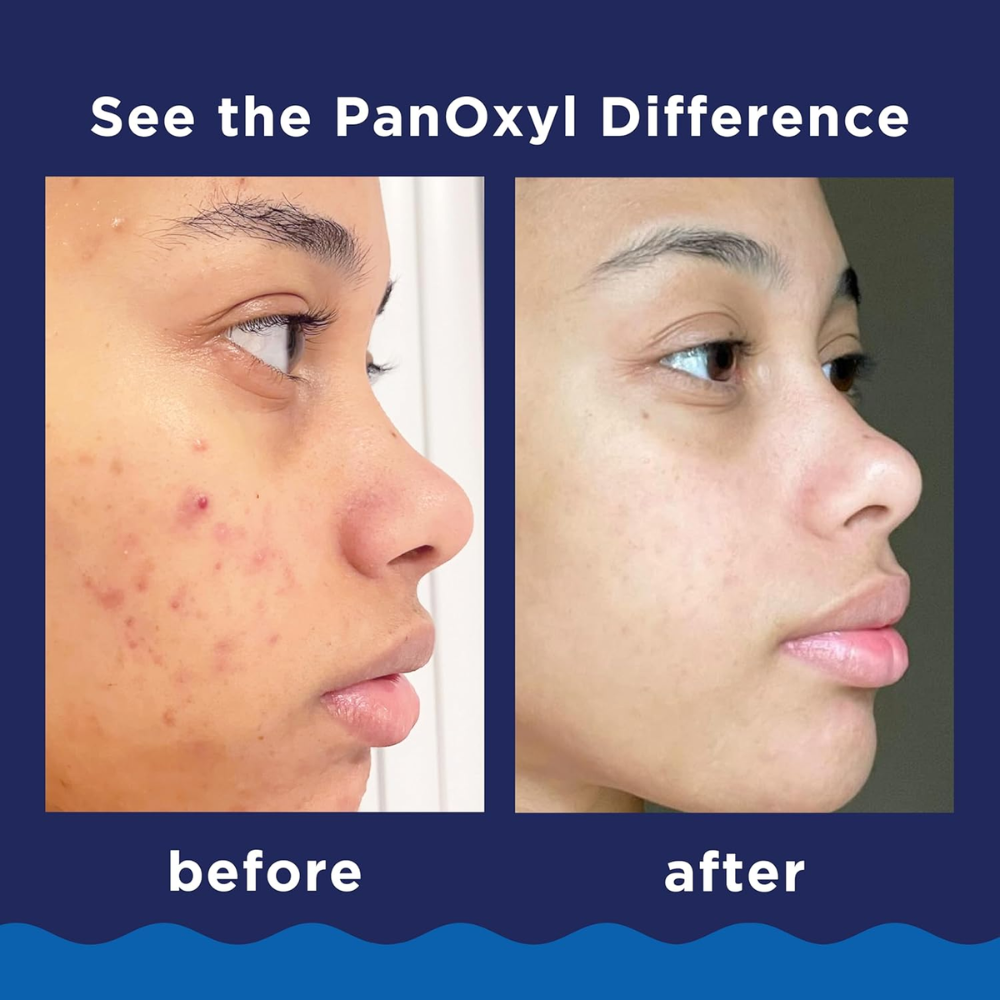 PanOxyl Acne Foaming Wash with 10% benzoyl peroxide, antimicrobial facial cleanser, 5.5 oz bottle, for acne treatment
